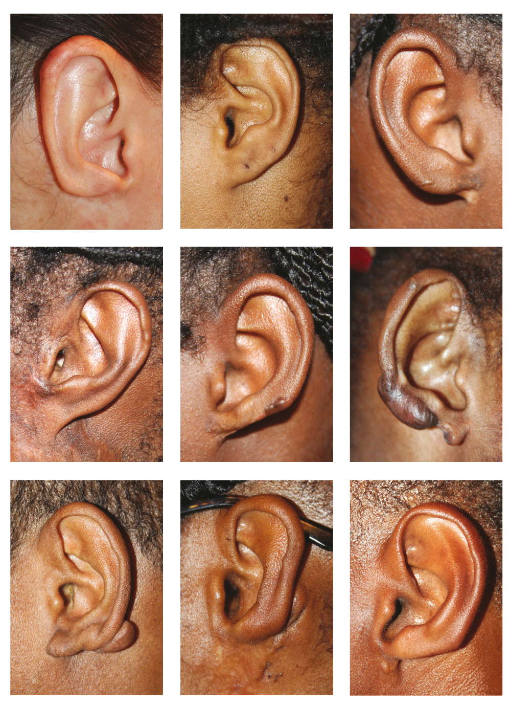 Massive ear keloids Natural history, evaluation of... F1000Research