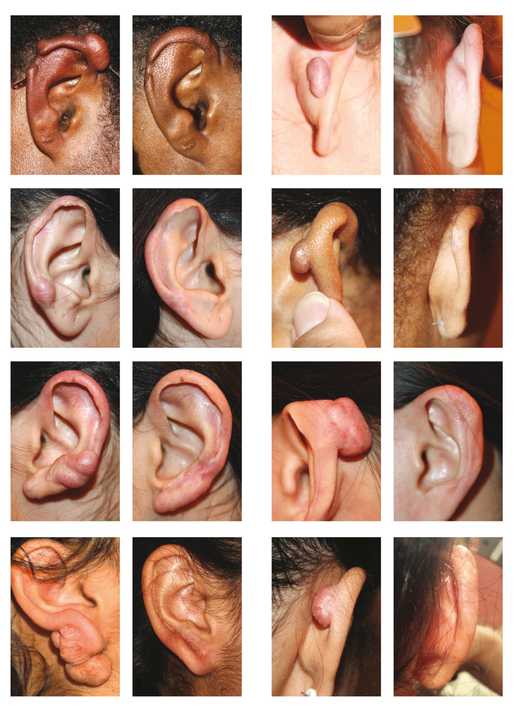 Massive ear keloids Natural history, evaluation of... F1000Research