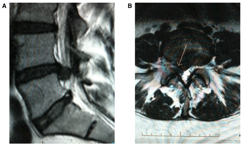 Case report Intradiscal oxygen ozone therapy in... F1000Research