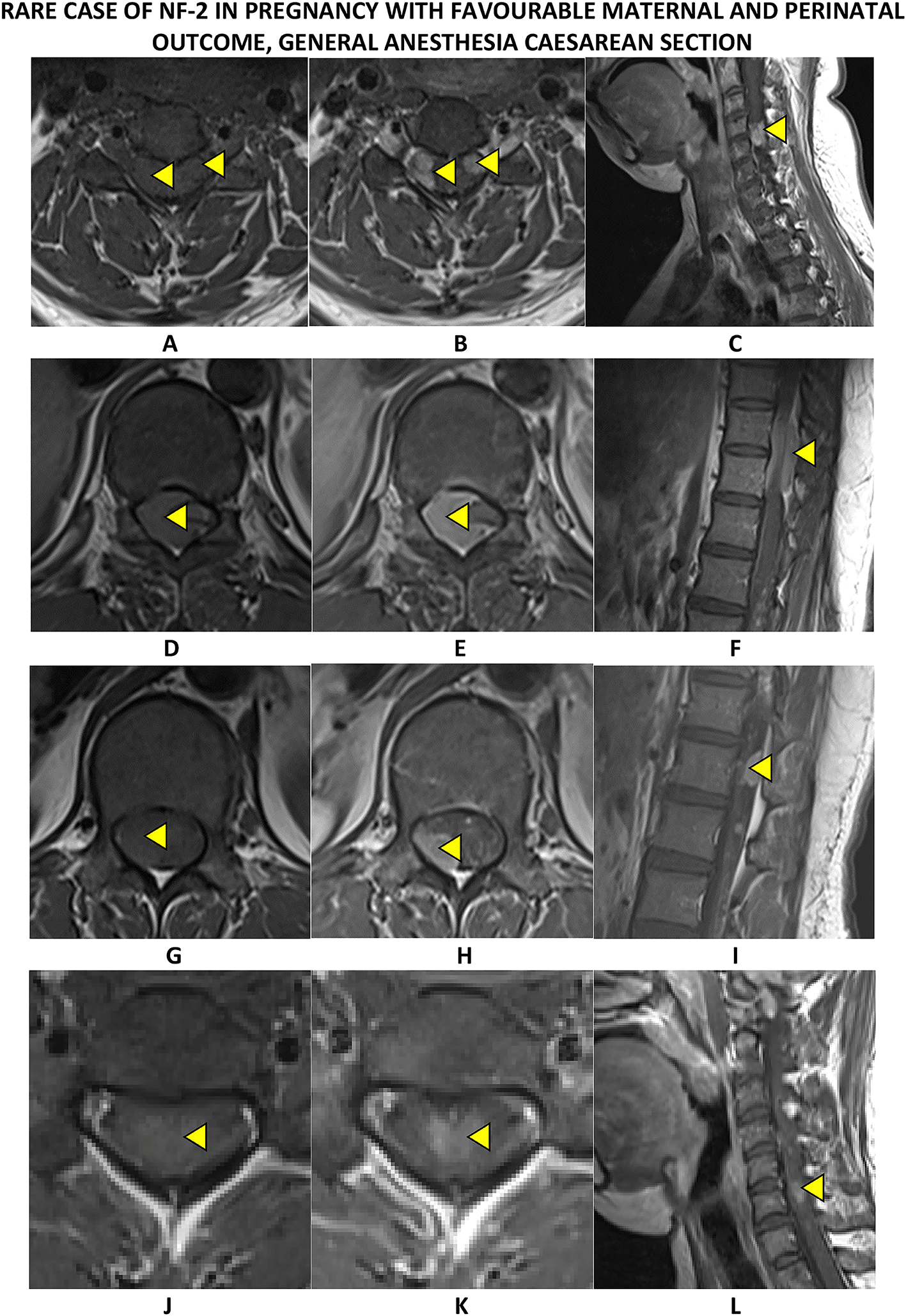 Case Report: Rare Case of NF2 in Pregnancy with... | F1000Research