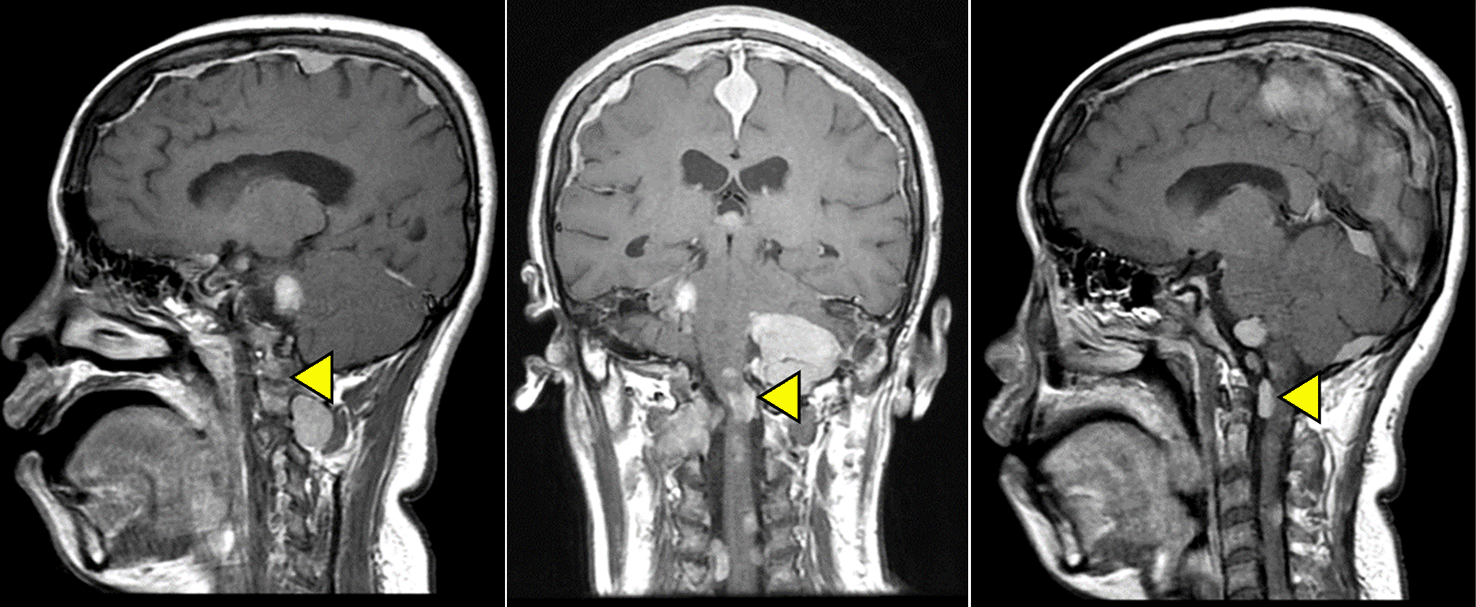 Case Report: Rare Case of NF2 in Pregnancy with... | F1000Research