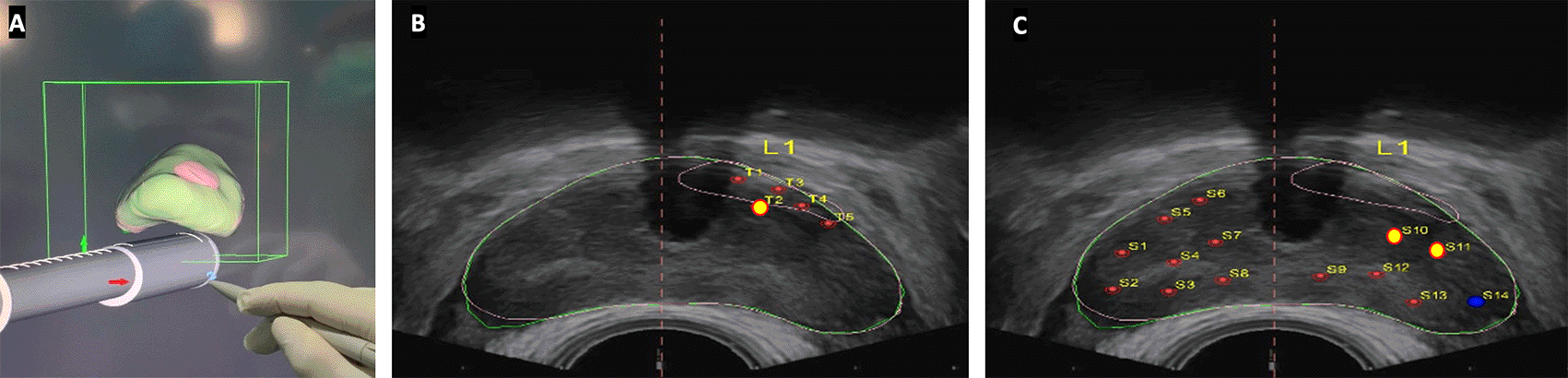 Case Report: High-grade anterior prostate cancer... | F1000Research