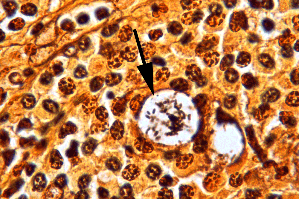 Rhinoscleroma presenting as a nasalpalatal mass... F1000Research