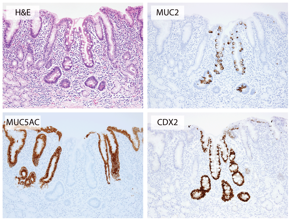 a microscopic focus of intestinal metaplasia in chronically