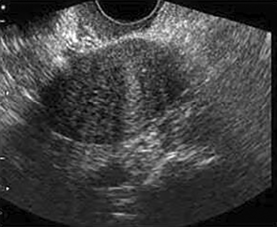 Case Report: Ovarian fibroma: typical... | F1000Research