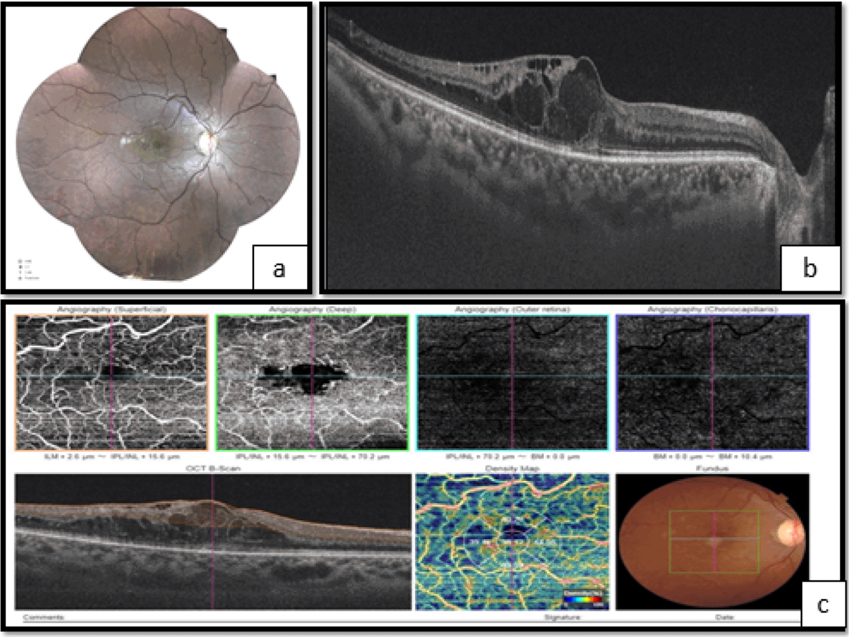 Case Report Optical coherence tomography... F1000Research