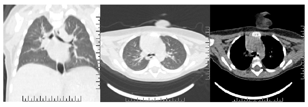 Case Report: Mucus plug in bronchus mimicking a... | F1000Research