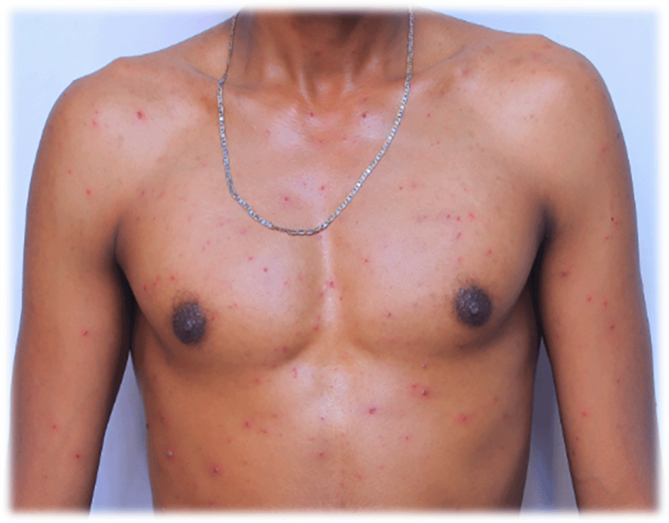 Case Report: Account of chickenpox progression over... | F1000Research
