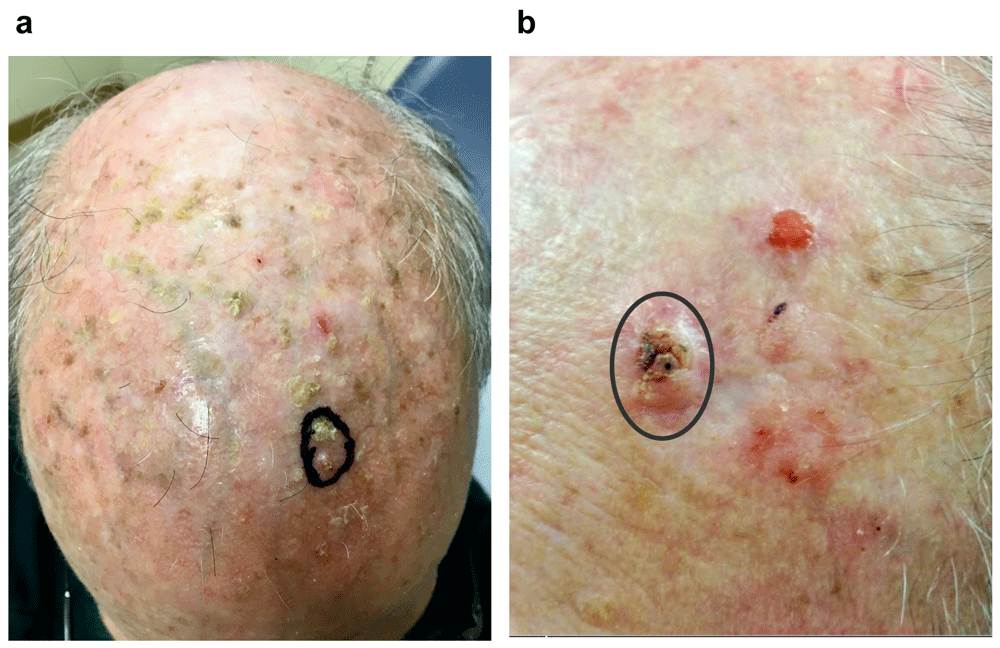 Recent advances in field cancerization and... F1000Research