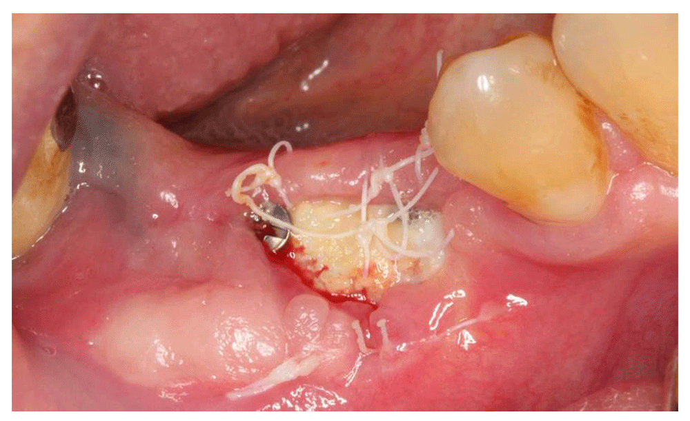 Case Report Managing the postoperative exposure of... F1000Research