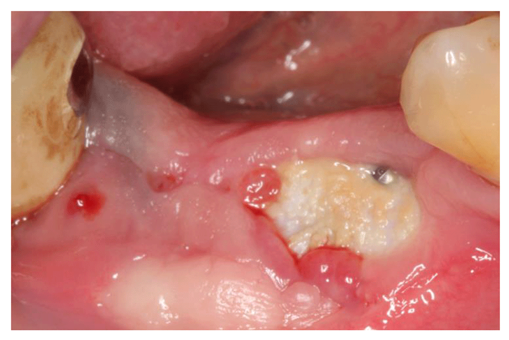 Case Report Managing the postoperative exposure of... F1000Research