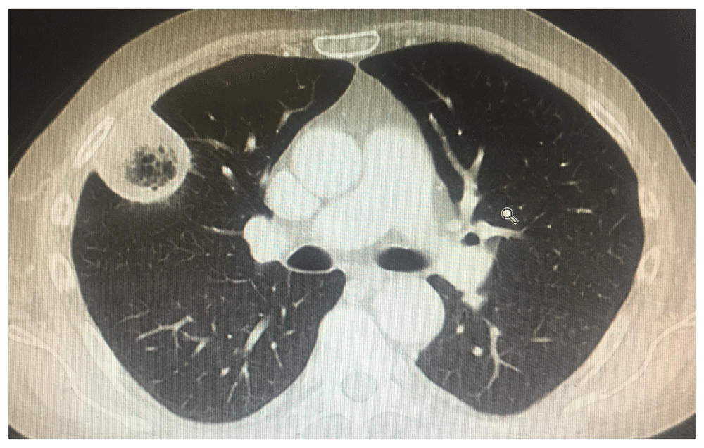 recent advances in the understanding and management of mucormy