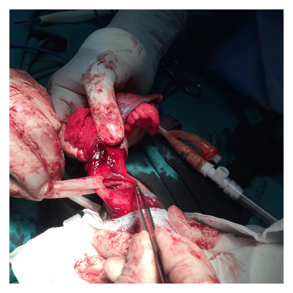 cefazoline 2gr iv was administered prophylactically before