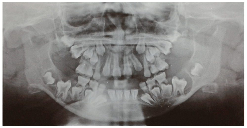Case Report: Dentigerous cyst marsupialization 