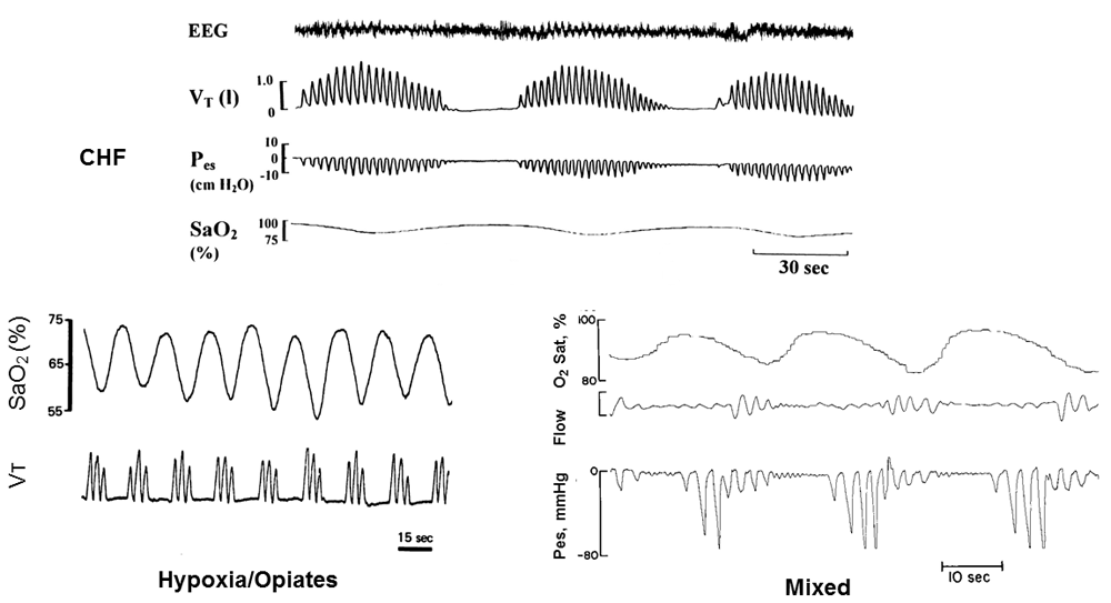 Central sleep apnea misunderstood and mistreated! F1000Research
