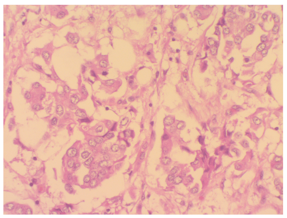 adenoca prostatic grade group 2 respuestas