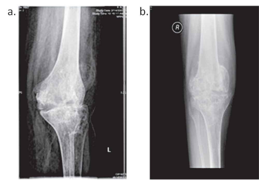 Ankylosis of the hips and knees due to sickle... F1000Research