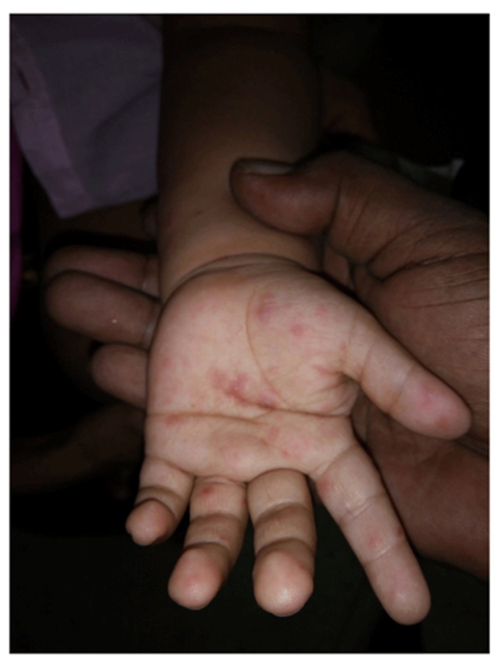 Emerging Hand Foot Mouth Disease In Bangladeshi F1000research