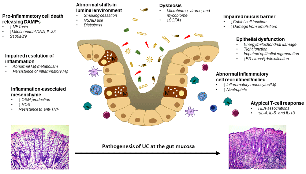 Ulcerative colitis Recent advances in the... F1000Research