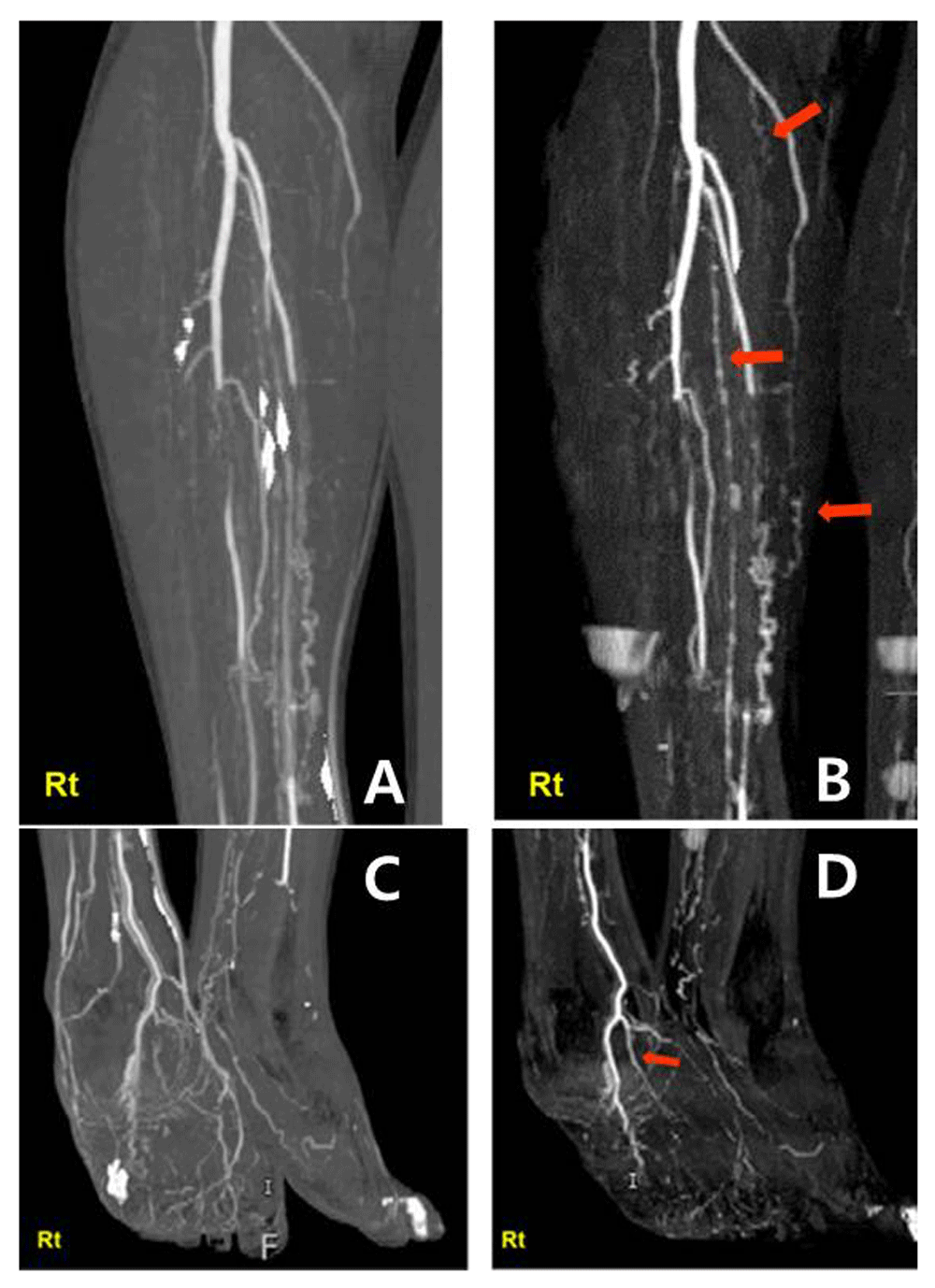 Treatment of Buerger’s disease... F1000Research
