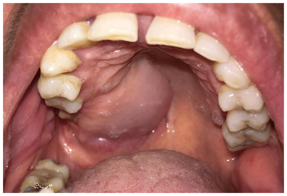 Case Report Rare site for intraoral meningioma F1000Research