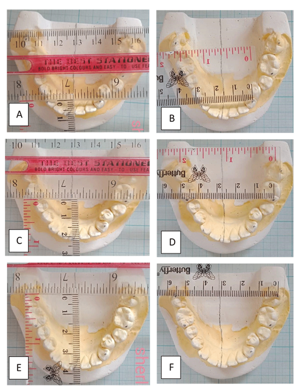 Evaluation of dental arches in orthodontic patients... F1000Research