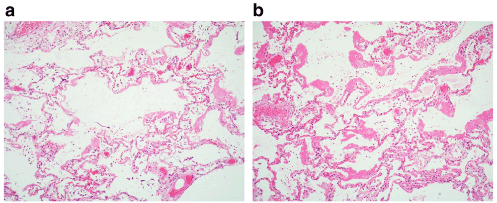 Case Report Suspected Covid 19 Death In The F1000research