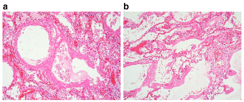 Case Report Suspected Covid 19 Death In The F1000research