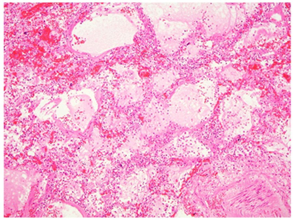 Case Report Suspected Covid 19 Death In The F1000research