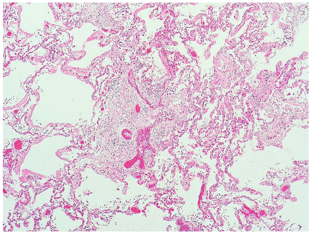 Case Report Suspected Covid 19 Death In The F1000research