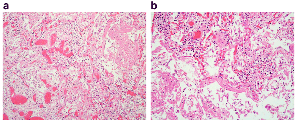 Case Report Suspected Covid 19 Death In The F1000research