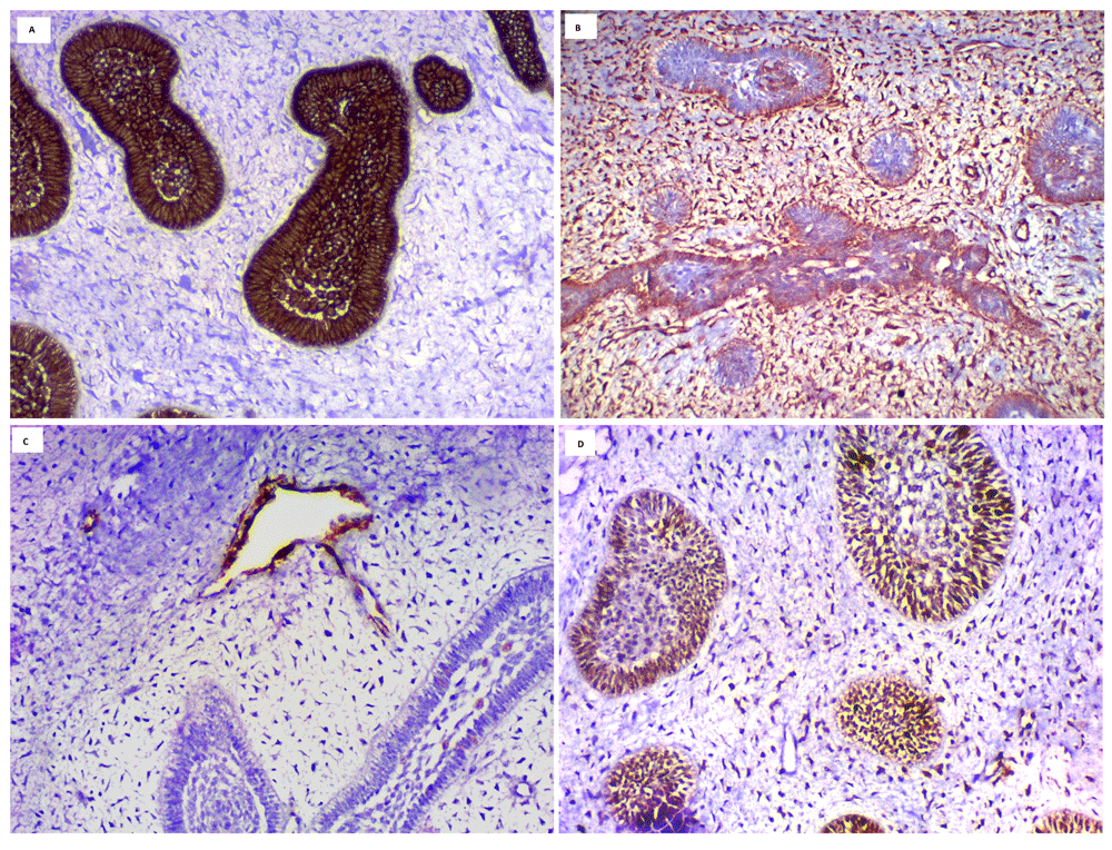 case report: odontogenic carcinosarcoma arising from amelo