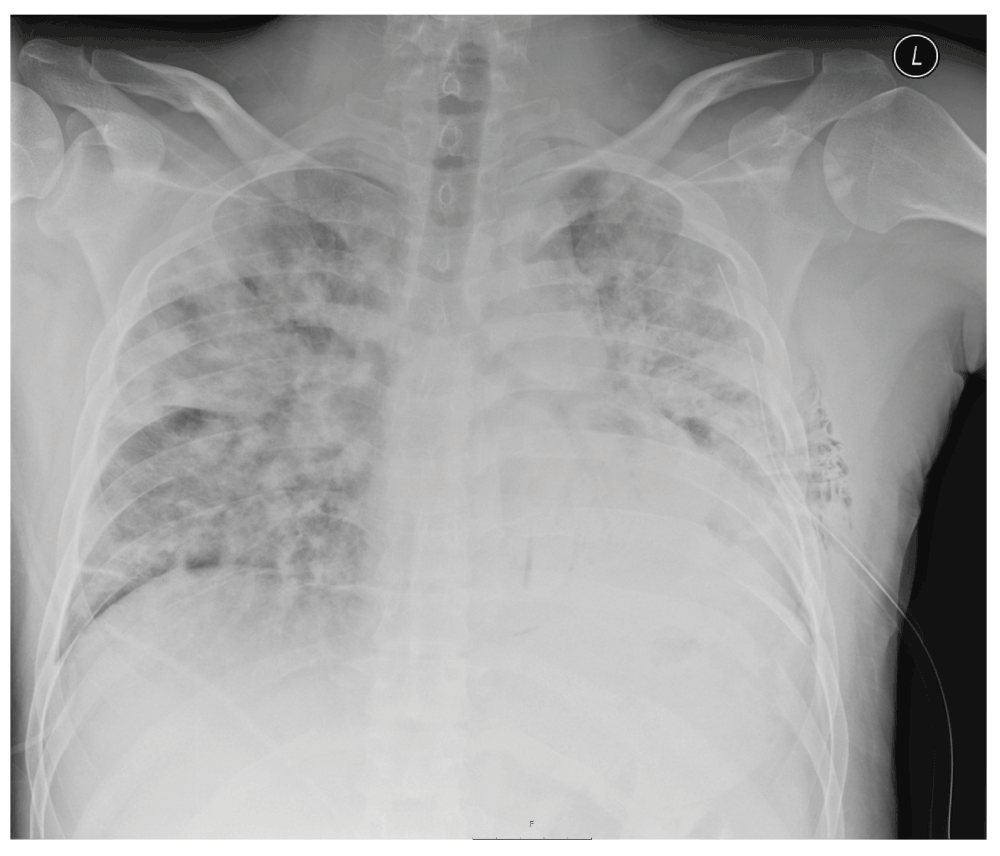 Chest Radiograph Showing Bilateral Pulmonary Edema Openi Chest