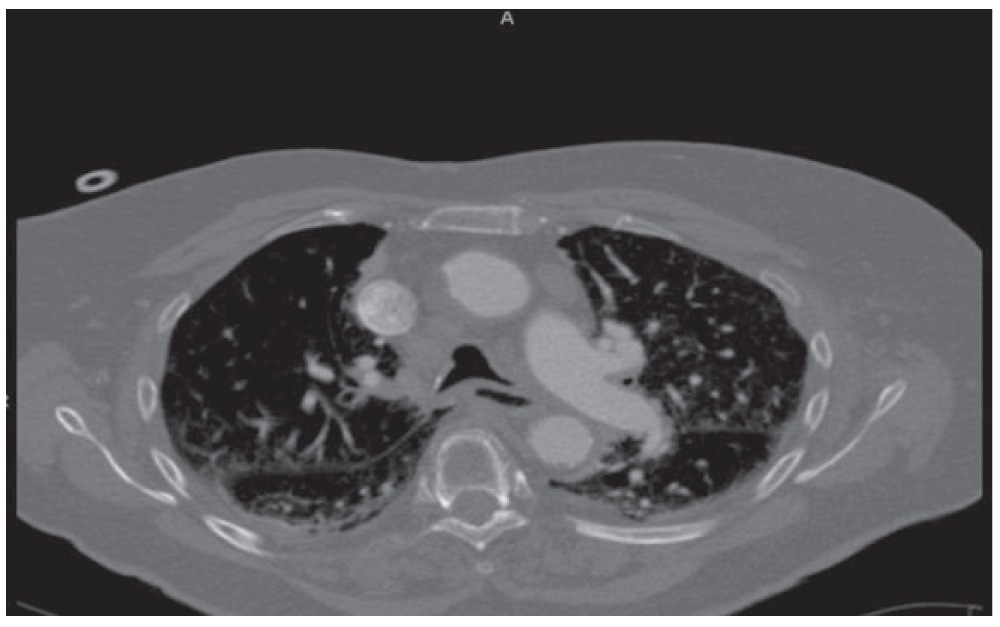 Case Report Nitrofurantoininduced interstitial... F1000Research