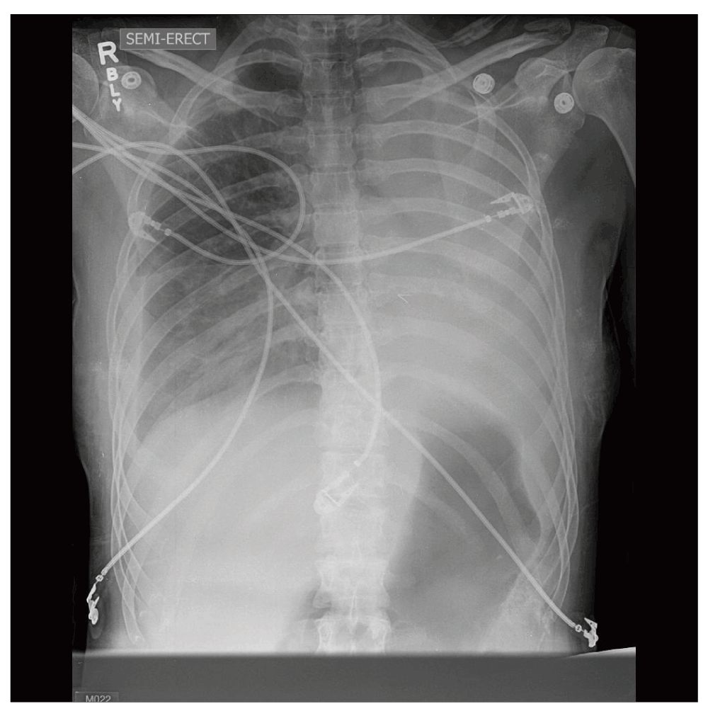 Case Report Perioperative management of a pregnant... F1000Research