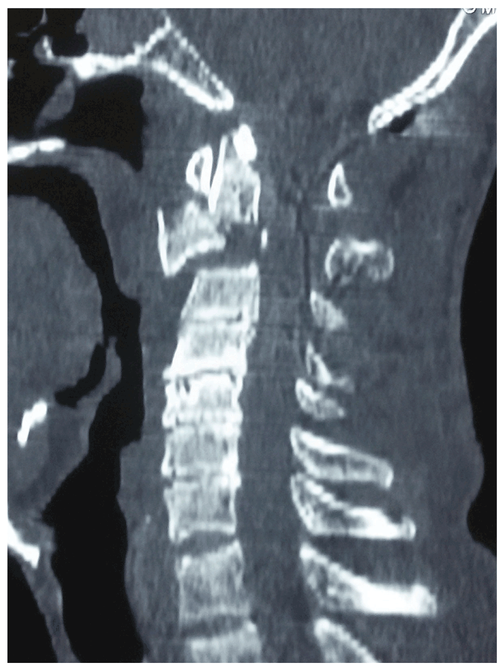 Can spondylolisthesis be reversed picture