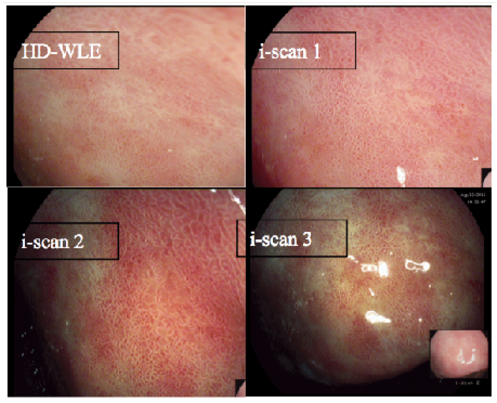 Advances in upper gastrointestinal endoscopy F1000Research