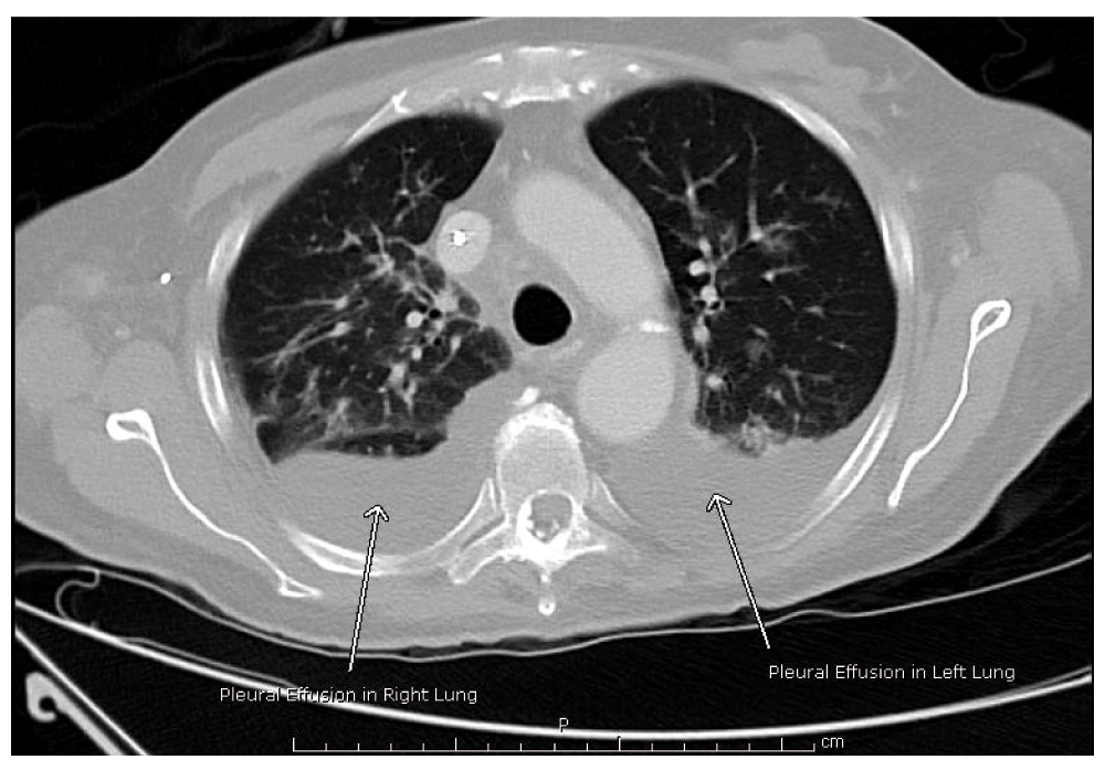figure 2. ct of the chest during hospitalization.