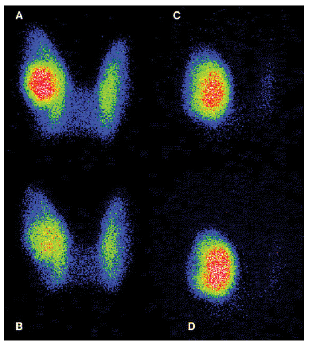 Thyroid scintigraphy Thyroid scintigraphy